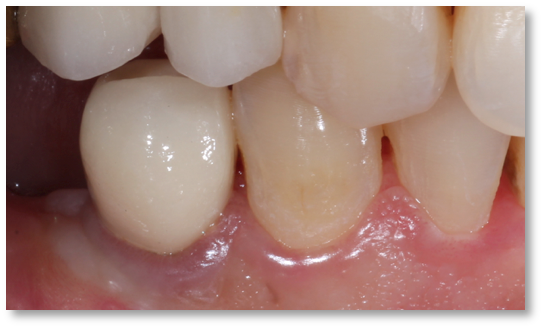 Gum disease example