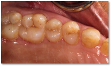 Gum disease example